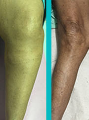 ARE YOU OR ANY OF YOUR FAMILY MEMBERS CONSIDERING TOTAL KNEE REPLACEMENT? ARE YOU OR ANY OF YOUR FAMILY MEMBERS CONSIDERING TOTAL KNEE REPLACEMENT?